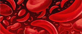 Sickle-Cell-Disease-1_cropped photo