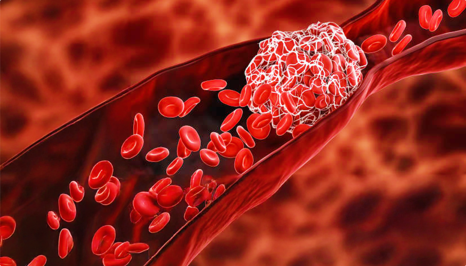 A photo of sticky red blood cell in artery