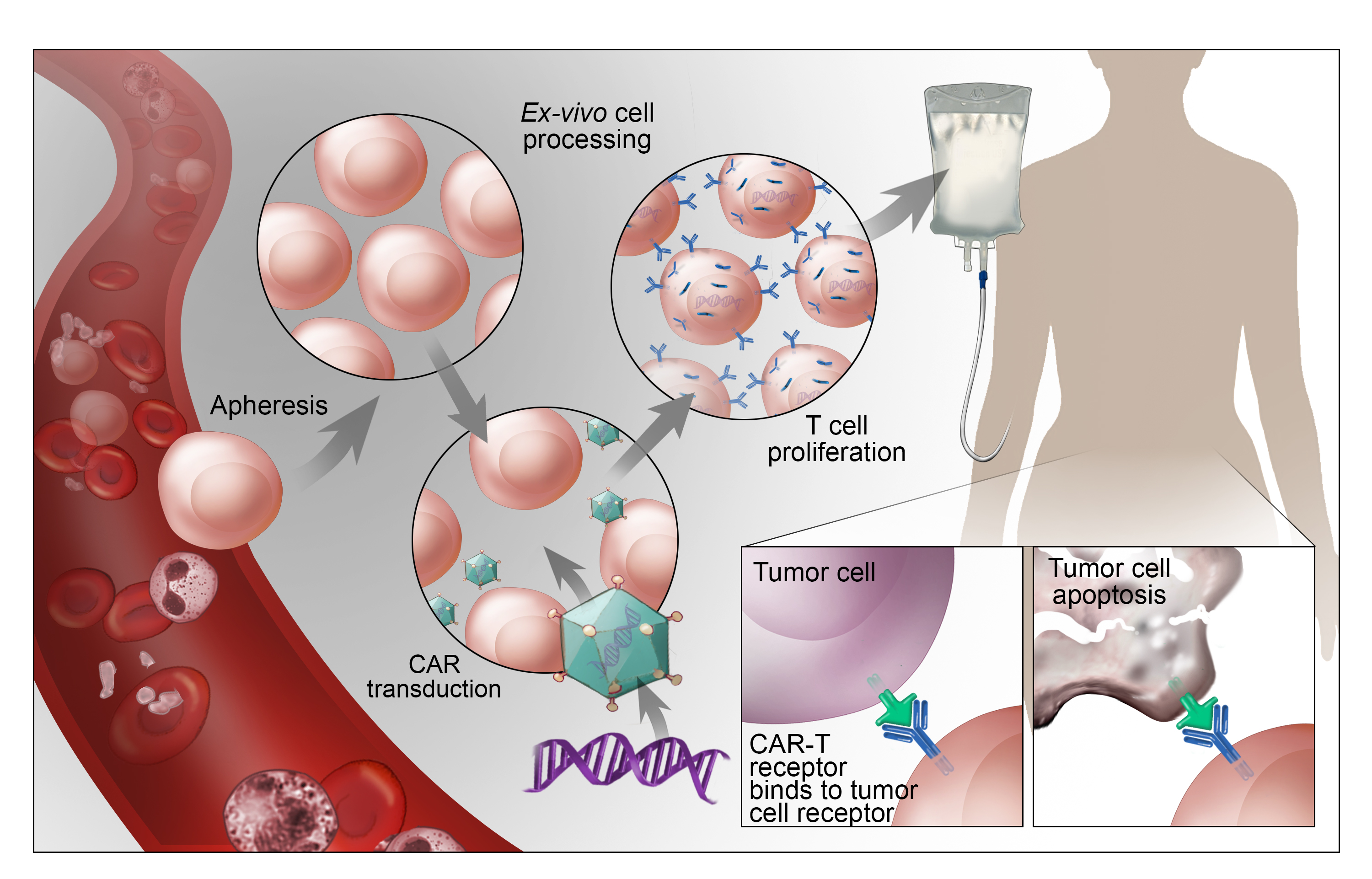 A diagram depicting CAR-T processes