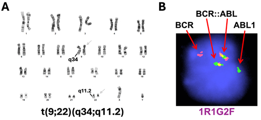 Figure 3. Cytogenetic and FISH detection of the BCR::ABL1 translocation